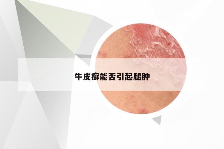 牛皮癣能否引起腿肿