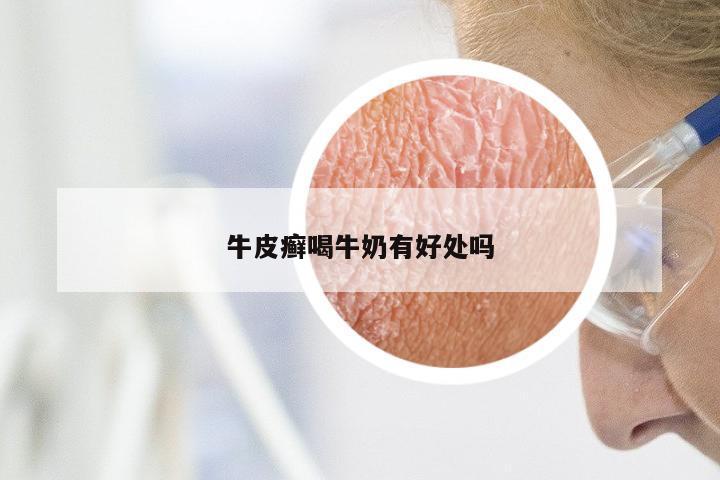 牛皮癣喝牛奶有好处吗