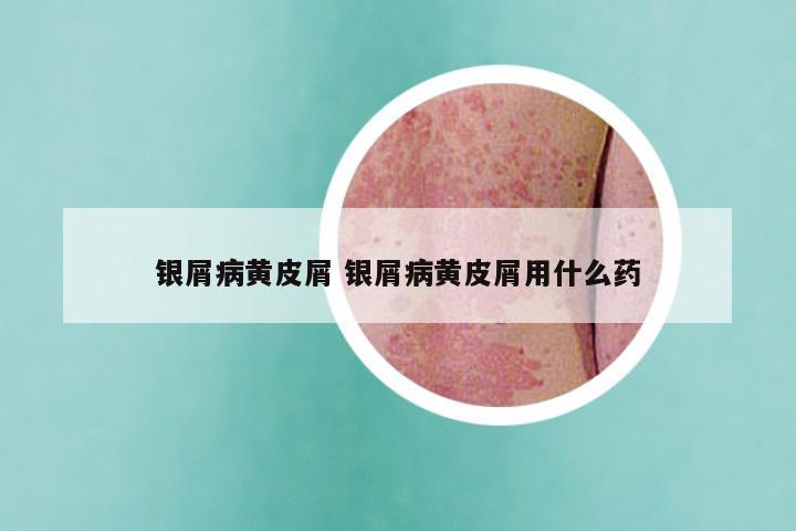 银屑病黄皮屑 银屑病黄皮屑用什么药