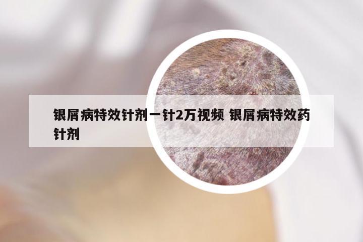 银屑病特效针剂一针2万视频 银屑病特效药针剂
