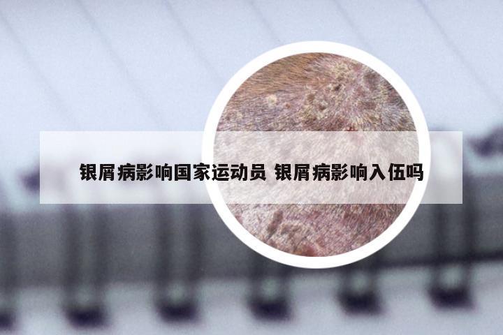 银屑病影响国家运动员 银屑病影响入伍吗