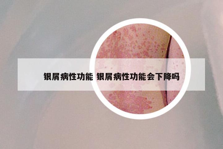 银屑病性功能 银屑病性功能会下降吗