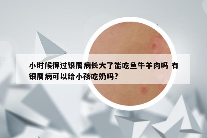 小时候得过银屑病长大了能吃鱼牛羊肉吗 有银屑病可以给小孩吃奶吗?
