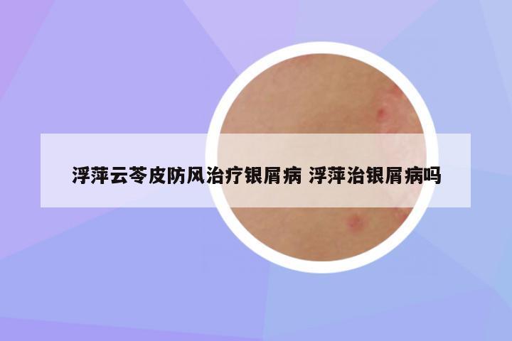 浮萍云苓皮防风治疗银屑病 浮萍治银屑病吗