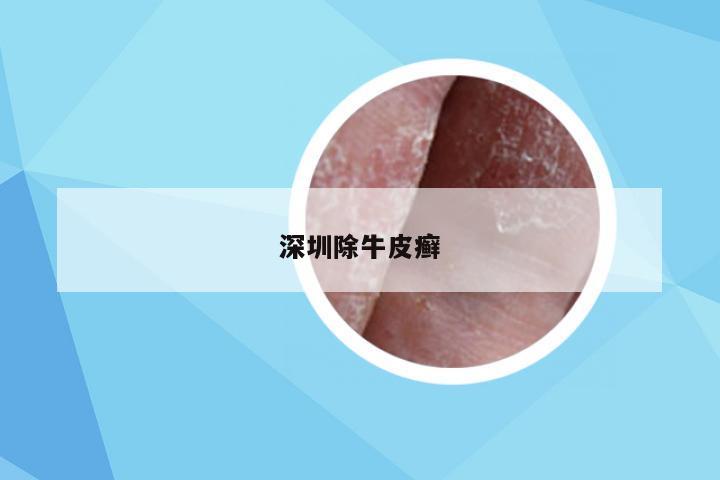 深圳除牛皮癣
