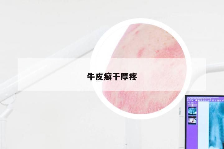 牛皮癣干厚疼