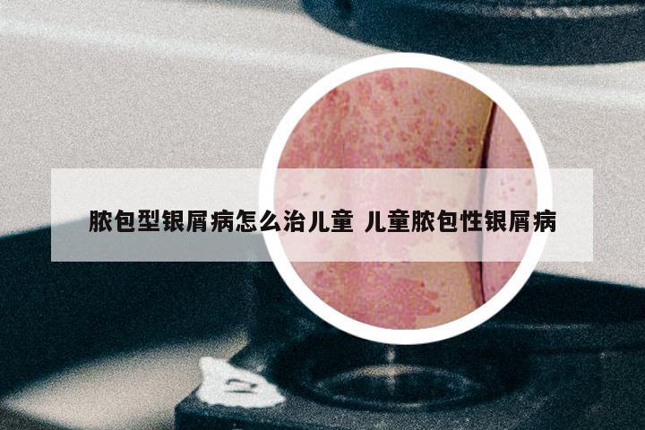 脓包型银屑病怎么治儿童 儿童脓包性银屑病