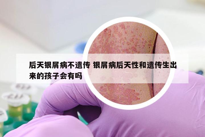 后天银屑病不遗传 银屑病后天性和遗传生出来的孩子会有吗