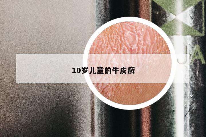 10岁儿童的牛皮癣