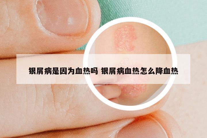 银屑病是因为血热吗 银屑病血热怎么降血热