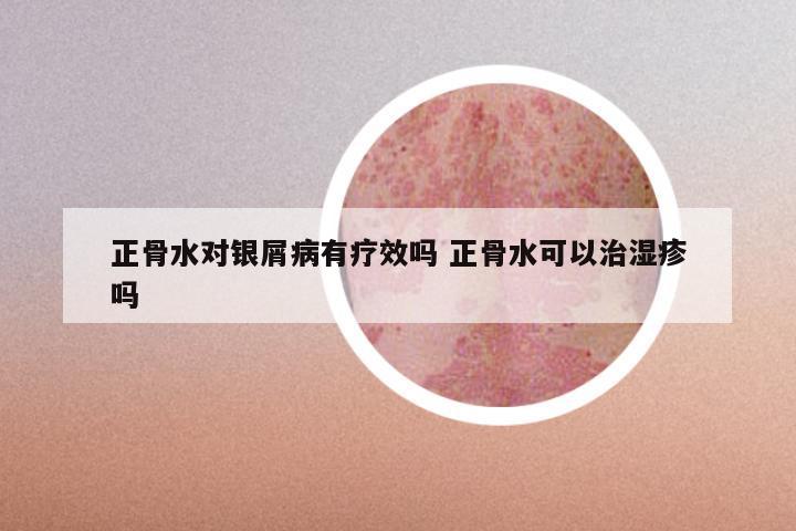 正骨水对银屑病有疗效吗 正骨水可以治湿疹吗