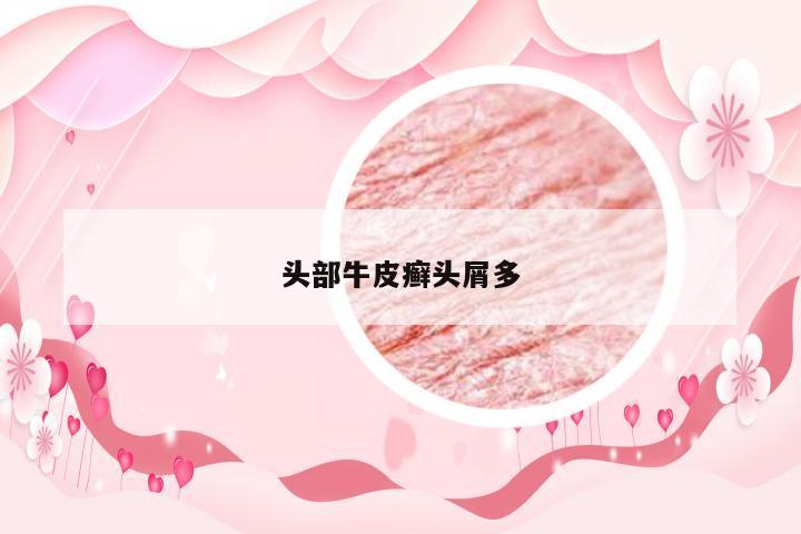 头部牛皮癣头屑多