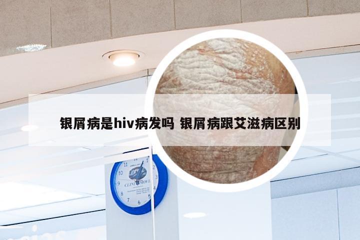 银屑病是hiv病发吗 银屑病跟艾滋病区别