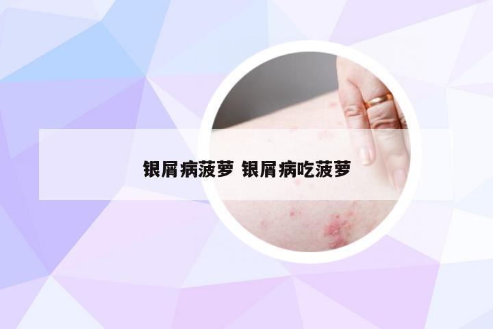 银屑病菠萝 银屑病吃菠萝