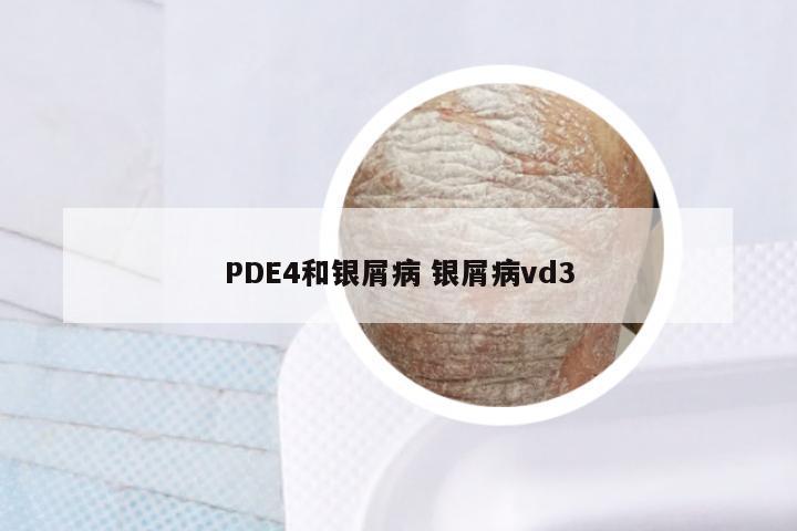 PDE4和银屑病 银屑病vd3