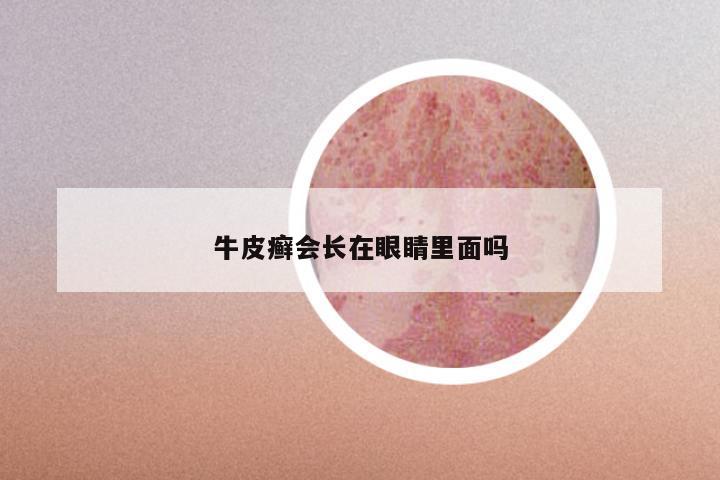 牛皮癣会长在眼睛里面吗
