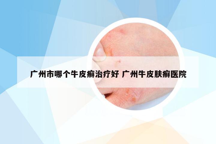 广州市哪个牛皮癣治疗好 广州牛皮肤癣医院
