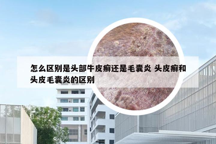 怎么区别是头部牛皮癣还是毛囊炎 头皮癣和头皮毛囊炎的区别