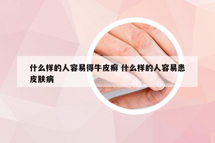 什么样的人容易得牛皮癣 什么样的人容易患皮肤病