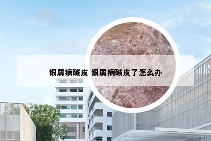 银屑病破皮 银屑病破皮了怎么办