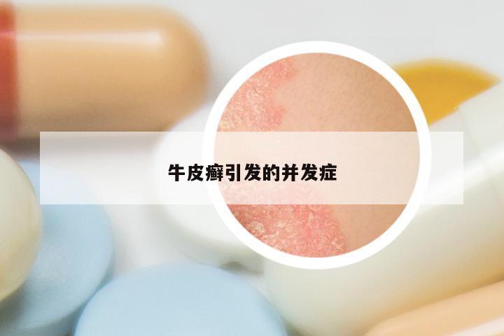 牛皮癣引发的并发症