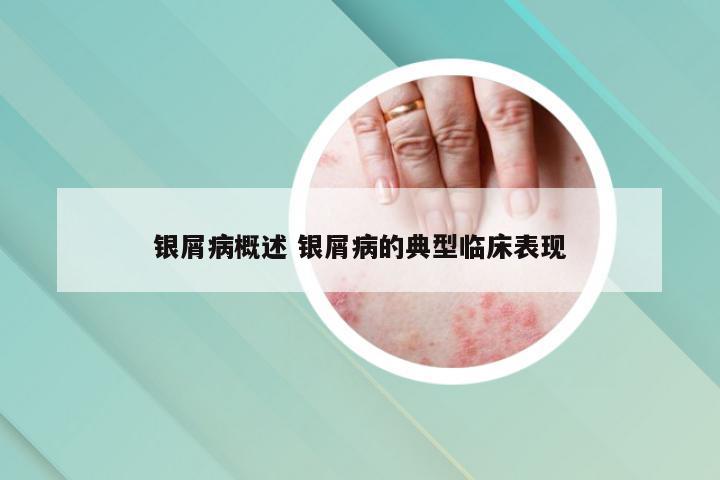 银屑病概述 银屑病的典型临床表现
