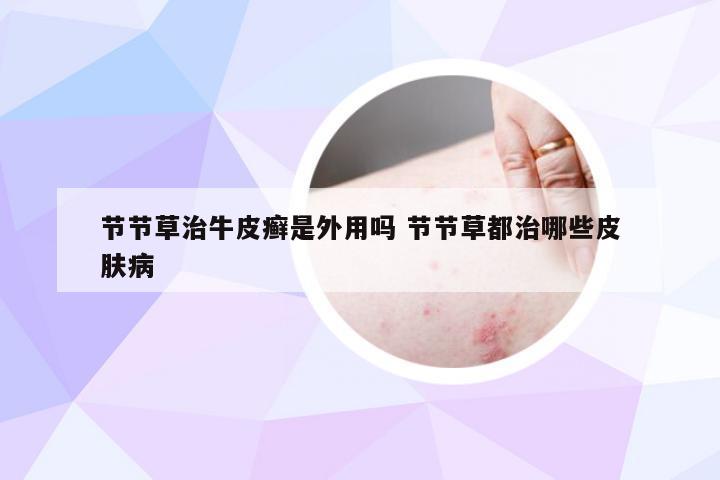 节节草治牛皮癣是外用吗 节节草都治哪些皮肤病