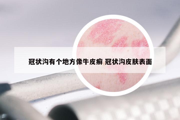 冠状沟有个地方像牛皮癣 冠状沟皮肤表面