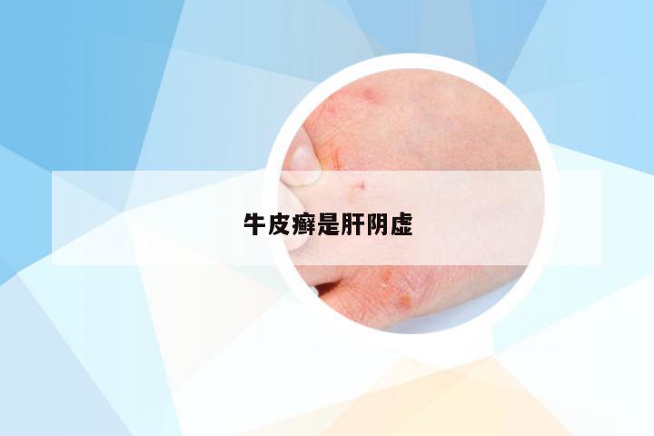 牛皮癣是肝阴虚