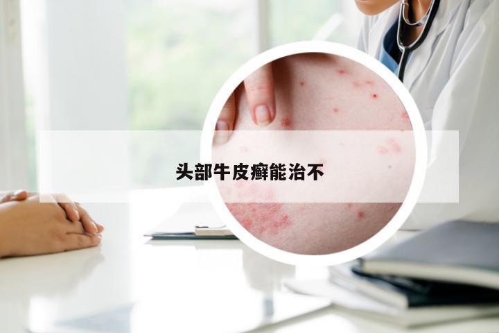 头部牛皮癣能治不