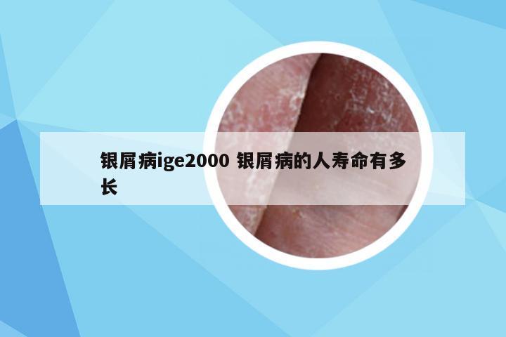 银屑病ige2000 银屑病的人寿命有多长