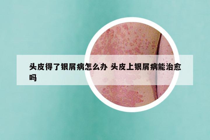 头皮得了银屑病怎么办 头皮上银屑病能治愈吗