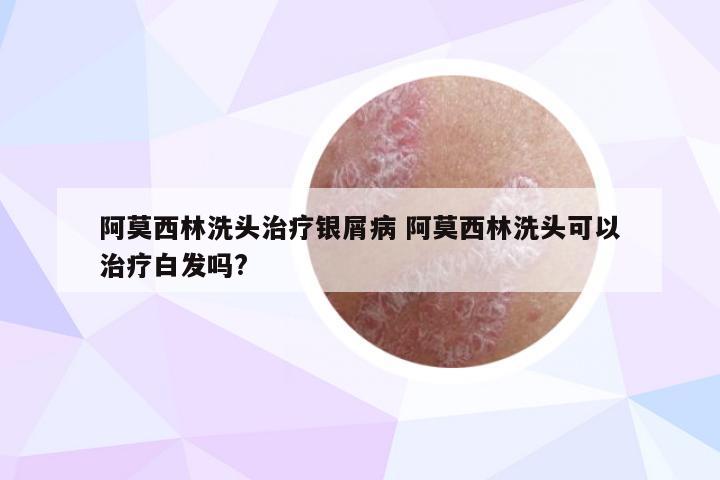 阿莫西林洗头治疗银屑病 阿莫西林洗头可以治疗白发吗?