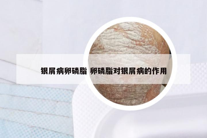 银屑病卵磷脂 卵磷脂对银屑病的作用