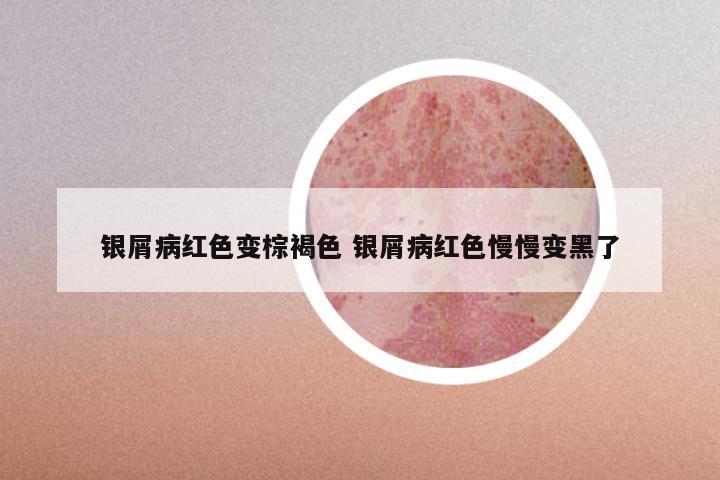 银屑病红色变棕褐色 银屑病红色慢慢变黑了