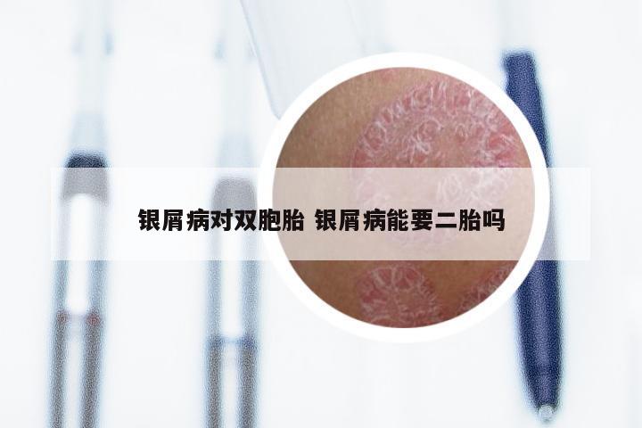 银屑病对双胞胎 银屑病能要二胎吗