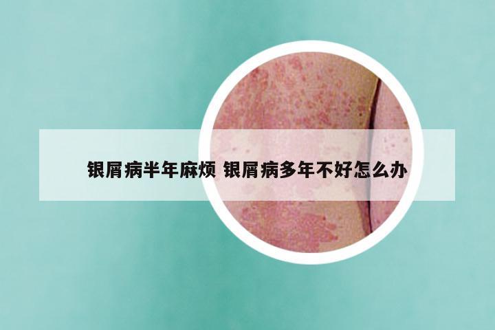 银屑病半年麻烦 银屑病多年不好怎么办