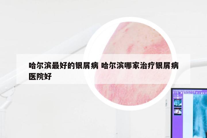 哈尔滨最好的银屑病 哈尔滨哪家治疗银屑病医院好