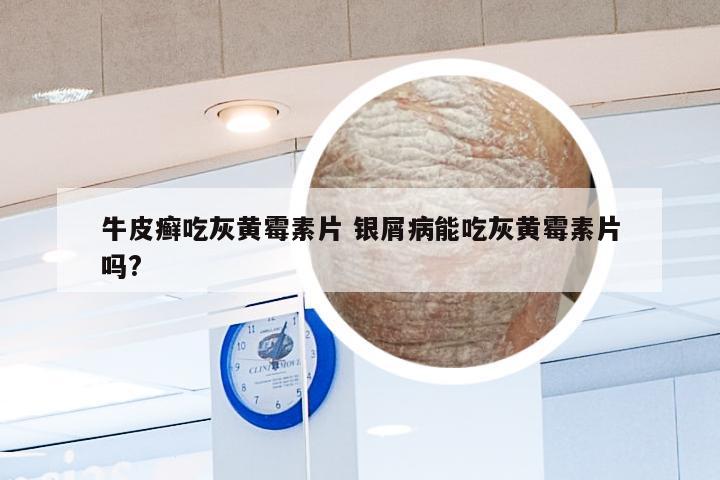 牛皮癣吃灰黄霉素片 银屑病能吃灰黄霉素片吗?