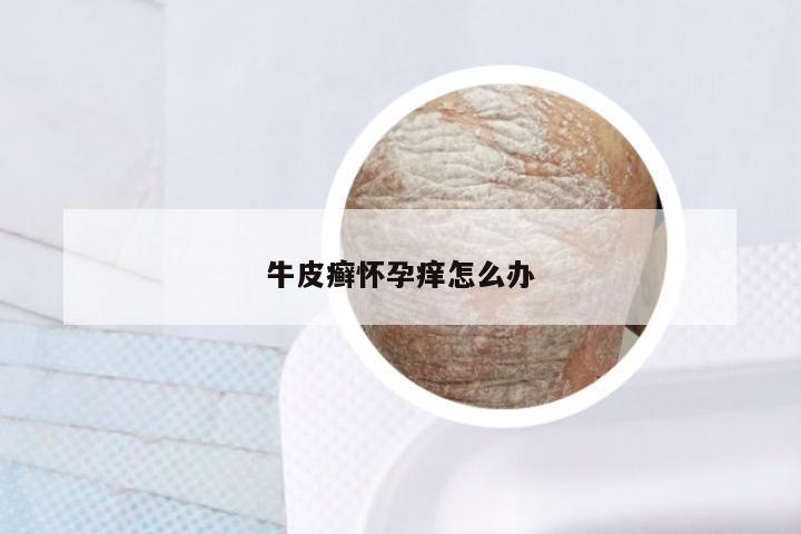 牛皮癣怀孕痒怎么办