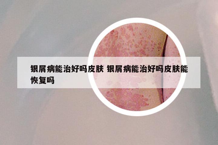 银屑病能治好吗皮肤 银屑病能治好吗皮肤能恢复吗