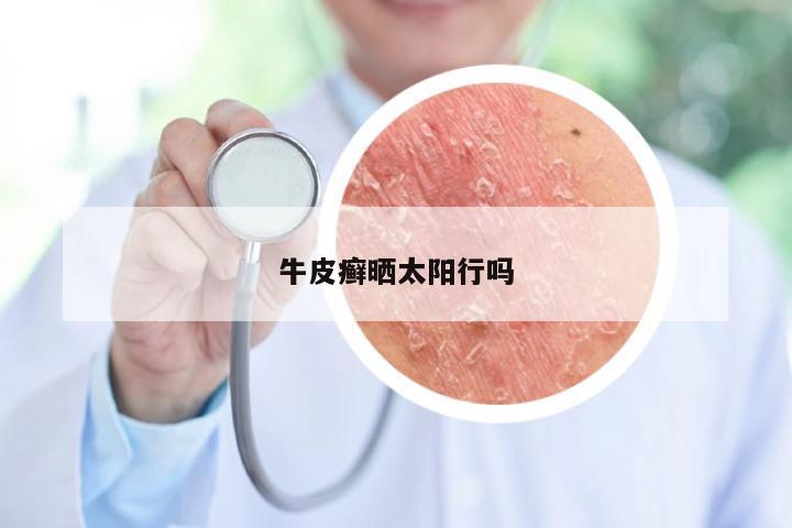 牛皮癣晒太阳行吗
