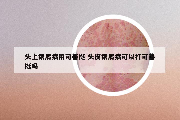 头上银屑病用可善挺 头皮银屑病可以打可善挺吗