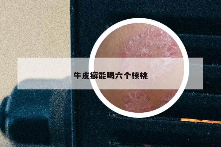 牛皮癣能喝六个核桃