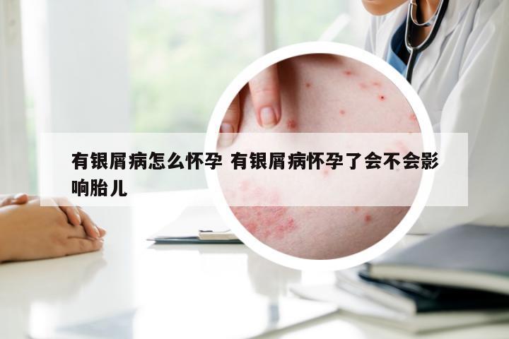 有银屑病怎么怀孕 有银屑病怀孕了会不会影响胎儿