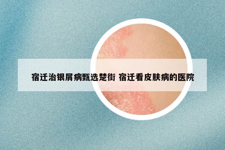 宿迁治银屑病甄选楚街 宿迁看皮肤病的医院