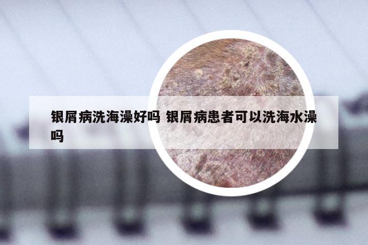 银屑病洗海澡好吗 银屑病患者可以洗海水澡吗