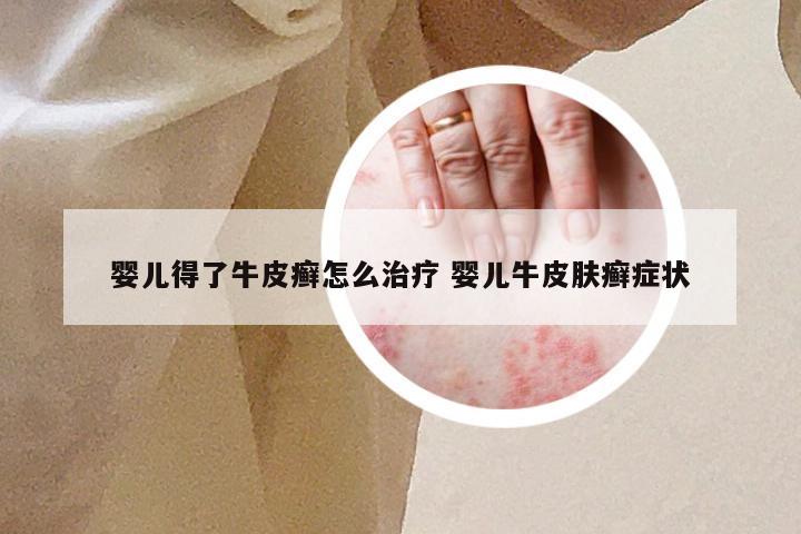 婴儿得了牛皮癣怎么治疗 婴儿牛皮肤癣症状