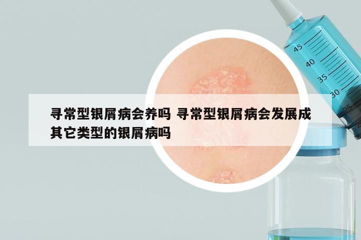 寻常型银屑病会养吗 寻常型银屑病会发展成其它类型的银屑病吗