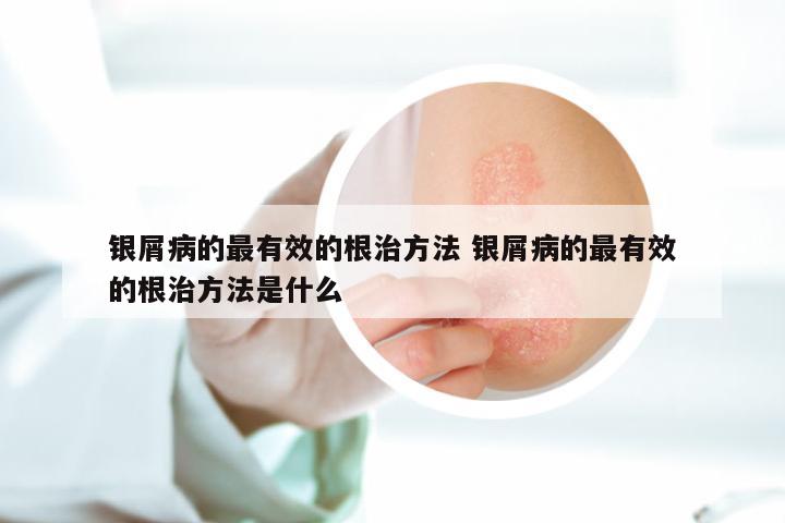 银屑病的最有效的根治方法 银屑病的最有效的根治方法是什么